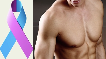 male-breast-cancer11